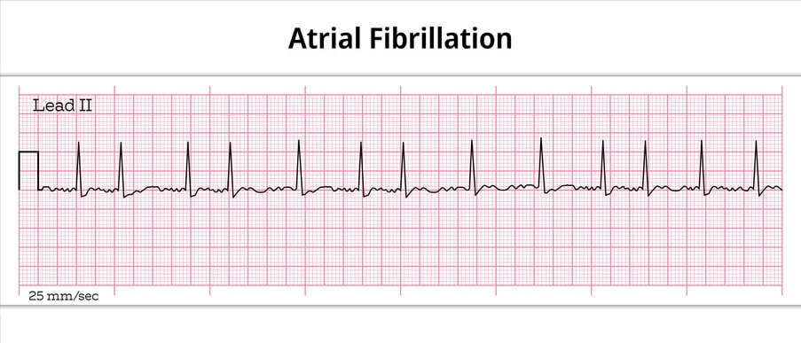 Atrial Flutter & Atrial Fibrillation Treatment in Sugar Land