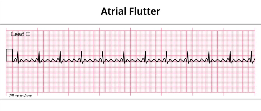 Atrial Flutter & Atrial Fibrillation Treatment in Sugar Land