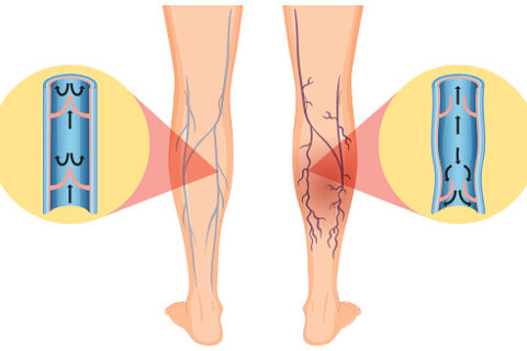 Human legs with varicose vein illustration